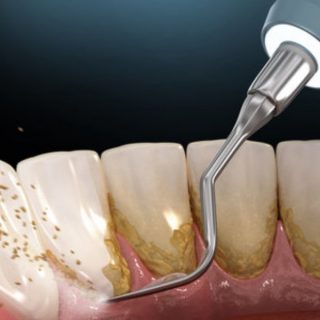 ukloniti zubni kamenac