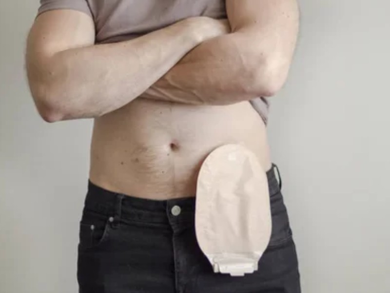 stoma